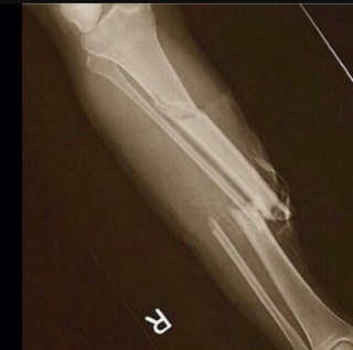 Illustration for article titled That Image Of "Paul George's X-Ray" Isn't Really His